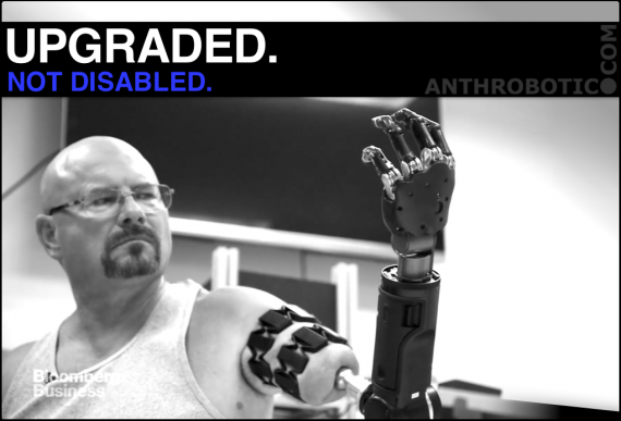 TRANSHUMANISM TEST PILOTS: Robotic Arm Connected Directly to Skeleton (VIDEO)